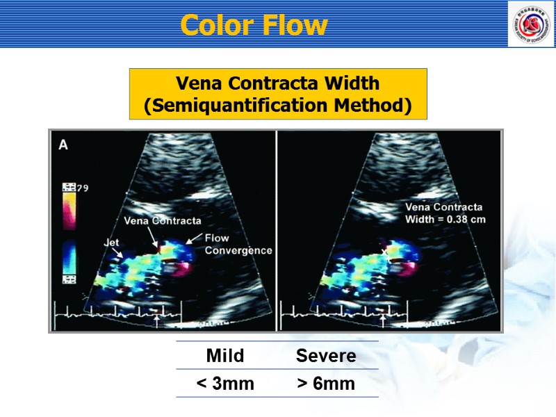 Vena Contracta Width (Semiquantification Method) Color Flow